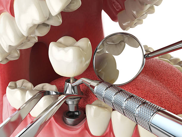 Best Emergency Wisdom Teeth Removal in Constantine, MI